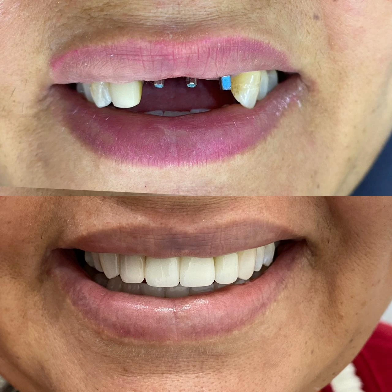 Antes e depois Nevinha